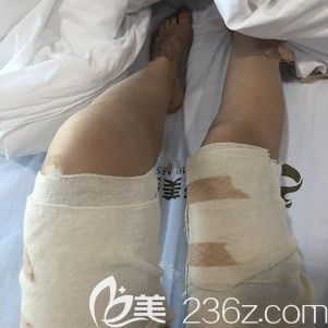 剛做完大腿吸脂術(shù)后即刻