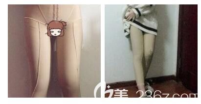 大腿吸脂術(shù)后一周穿著塑身衣