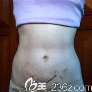 哈爾濱臻美吸脂瘦腰腹三天 哈爾濱臻美吸脂瘦腰腹三天