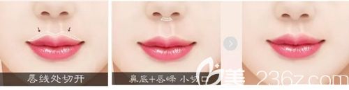 韓國MVP整形M唇整形