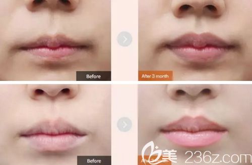 韓國MVP唇部整形案例