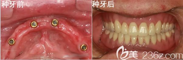 北京維樂口腔全口種植牙<span style= 北京維樂口腔全口種植牙<span style=