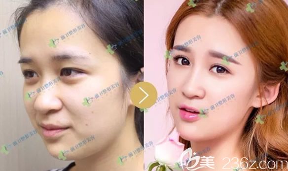 崔在宜昌前衛(wèi)整形醫(yī)院坐診時(shí)打造的玻尿酸注射美容效果圖