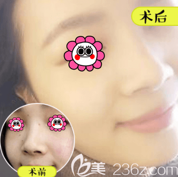 北京壹加壹李鳳苔醫(yī)生激光點(diǎn)痣案例