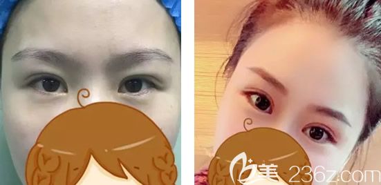 西安整形醫(yī)生張沙沙雙眼皮案例