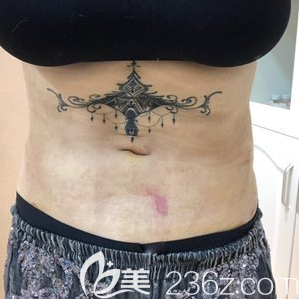 <i data-id='8cb641b3-5c99-43b6-9d58-783ebde4edf3' style='display:none;'></i>腰腹吸脂拆線后效果