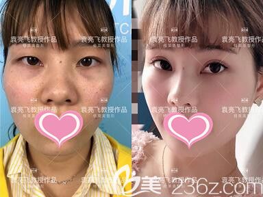 袁亮飛眼綜合真人前后效果對比照片 袁亮飛眼綜合真人前后效果對比照片