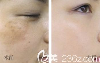 包頭葉子蘇明山祛斑效果怎么樣