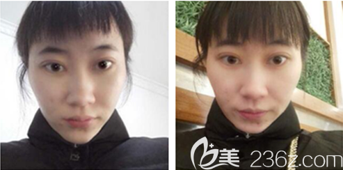 李正鵬激光祛斑術(shù)后一周