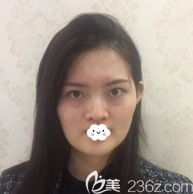 在<i data-id='2f3b027c-7adc-4bed-aa61-5d9313a5a76d' style='display:none;'></i>做鼻綜合術(shù)前照片 在<i data-id='2f3b027c-7adc-4bed-aa61-5d9313a5a76d' style='display:none;'></i>做鼻綜合術(shù)前照片