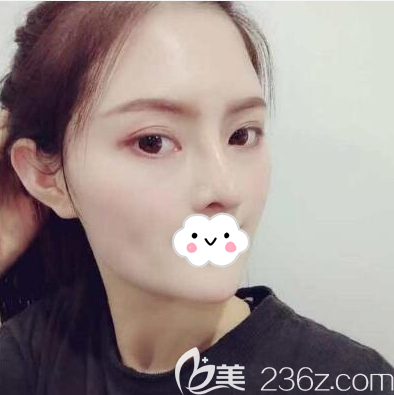 肋軟骨隆鼻拆線后側(cè)臉效果圖 肋軟骨隆鼻拆線后側(cè)臉效果圖