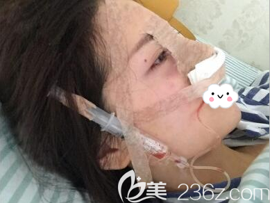 <i data-id='2f3b027c-7adc-4bed-aa61-5d9313a5a76d' style='display:none;'></i>楊勇肋軟骨隆鼻術(shù)后即刻 <i data-id='2f3b027c-7adc-4bed-aa61-5d9313a5a76d' style='display:none;'></i>楊勇肋軟骨隆鼻術(shù)后即刻