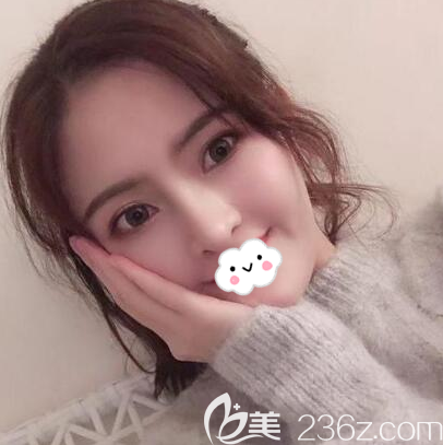 <i data-id='2f3b027c-7adc-4bed-aa61-5d9313a5a76d' style='display:none;'></i>鼻綜合術(shù)后45天效果圖 <i data-id='2f3b027c-7adc-4bed-aa61-5d9313a5a76d' style='display:none;'></i>鼻綜合術(shù)后45天效果圖