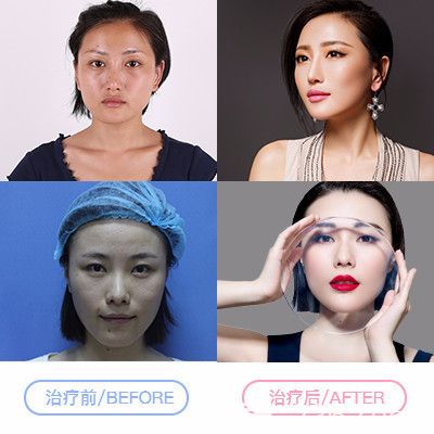 整形醫(yī)院超皮秒祛斑案例 整形醫(yī)院超皮秒祛斑案例