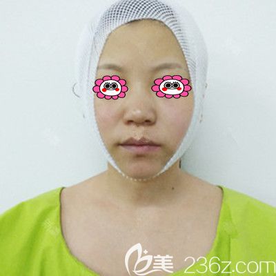 剛做完面部<span style=