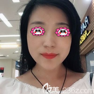 在湘潭雅美做完線雕的第三個月，趁著五一整形價格優(yōu)惠又定了面部脂肪填充項目