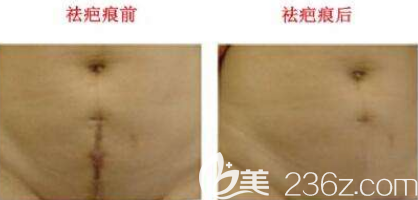 剖腹產(chǎn)疤痕能消除嗎？韓國激光祛疤痕案例圖