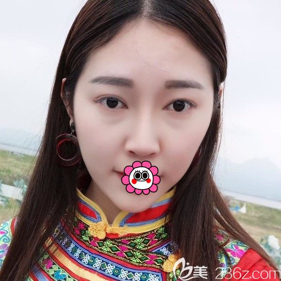 花了2800元在哈爾濱索菲找陳富全用硅膠墊下巴恢復(fù)三個月后秒變女神臉