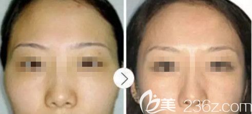 衡水唯美注射玻尿酸豐太陽穴案例