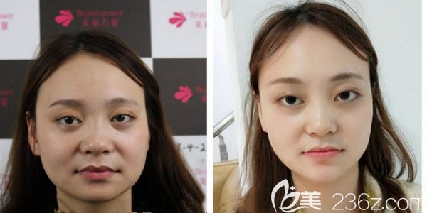 瘦臉除皺瘦臉+玻尿酸填充下巴后7天案例 瘦臉除皺瘦臉+玻尿酸填充下巴后7天案例