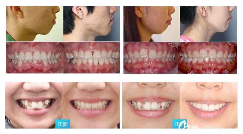 深圳拜爾口腔深覆合矯正和虎牙矯正案例圖 深圳拜爾口腔深覆合矯正和虎牙矯正案例圖