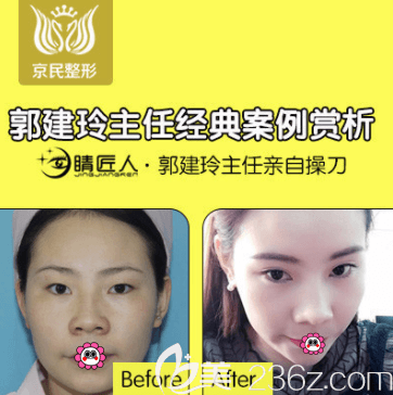 北京京民郭建玲醫(yī)生韓式無痕雙眼皮+開眼角案例