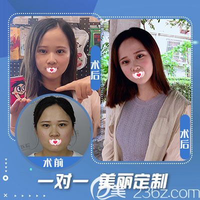 藍(lán)山整形醫(yī)院做雙眼皮案例