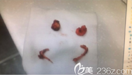 韓國(guó)本愛(ài)整形文圣昊顴骨內(nèi)退案例 韓國(guó)本愛(ài)整形文圣昊顴骨內(nèi)退案例