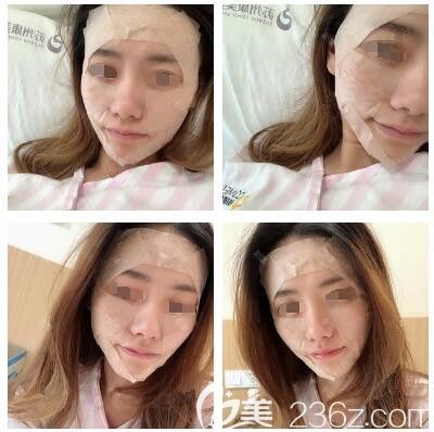 剛做完面部脂肪填充恢復中