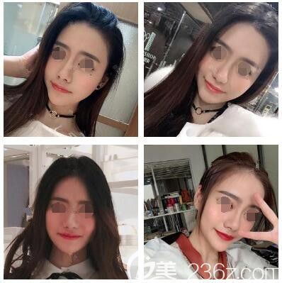 做完自體脂肪面部填充術后十天恢復