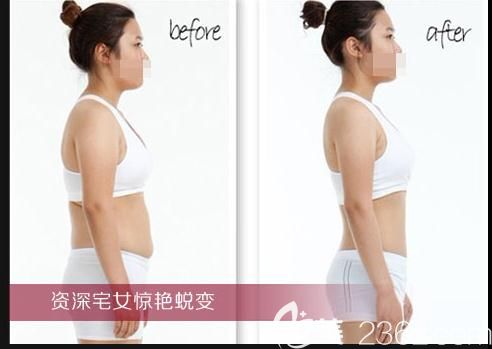 鄭州醫(yī)德佳整形吸脂瘦身案例