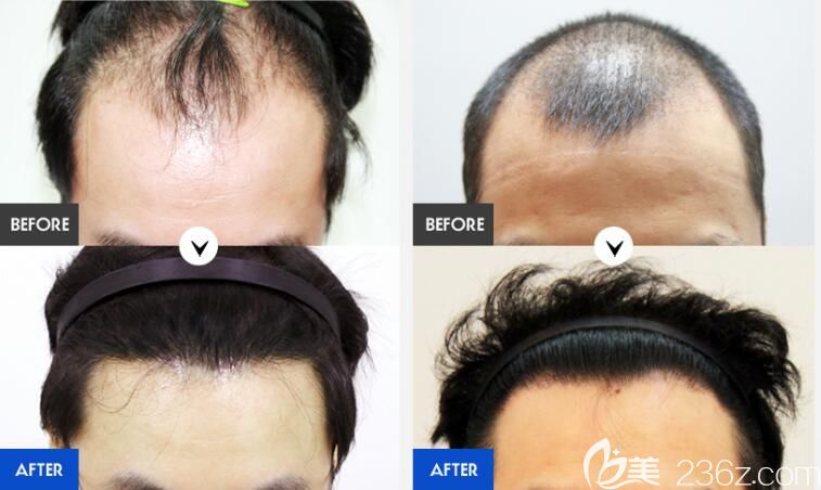 韓國forhair植發(fā)醫(yī)院男士植發(fā)案例效果對比圖 韓國forhair植發(fā)醫(yī)院男士植發(fā)案例效果對比圖