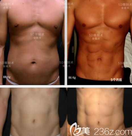 韓國(guó)cellpia整形醫(yī)院安敬天吸脂案例