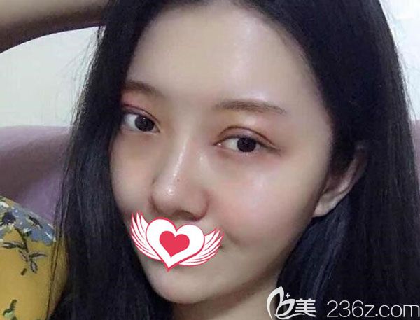 全切雙眼皮第7天眼周的淤青已經(jīng)慢慢變黃