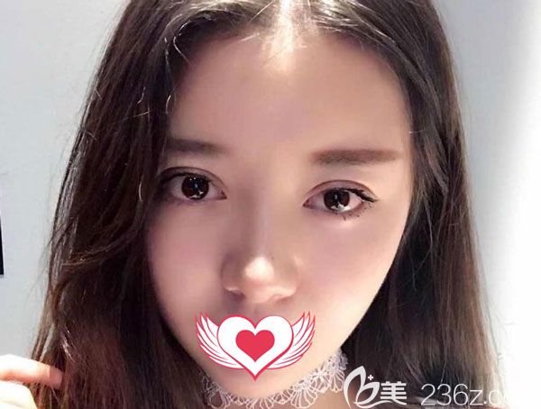 雙眼皮修復(fù)手術(shù)20天形態(tài)看起來非常自然