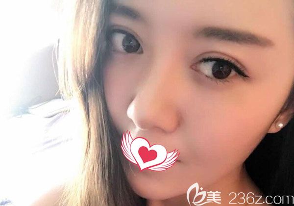 全切雙眼皮修復(fù)1個月基本已經(jīng)定型