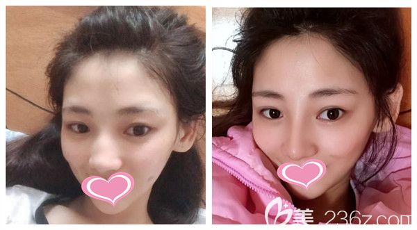 武漢壹加壹付俊俐蒙特鼻術(shù)后對比效果