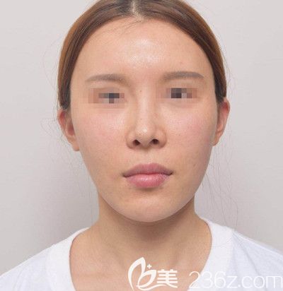 韓國EU做面部輪廓手術前 韓國EU做面部輪廓手術前