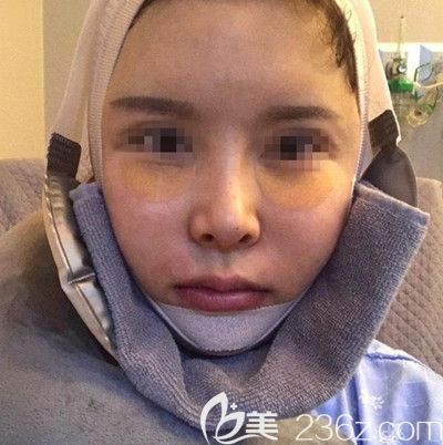 韓國EU做面部輪廓手術第當天 韓國EU做面部輪廓手術第當天