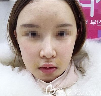 韓國EU做面部輪廓手術第3天 韓國EU做面部輪廓手術第3天