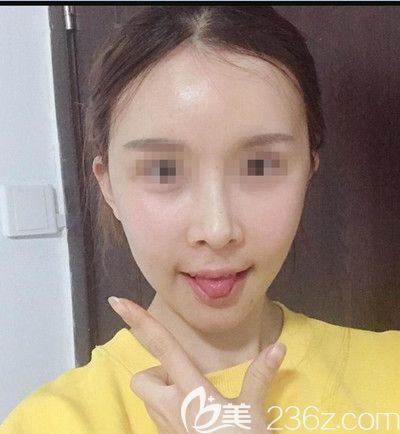 在韓國EU做面部輪廓手術后2周 在韓國EU做面部輪廓手術后2周