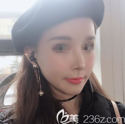 在韓國EU做面部輪廓手術后1個月 在韓國EU做面部輪廓手術后1個月