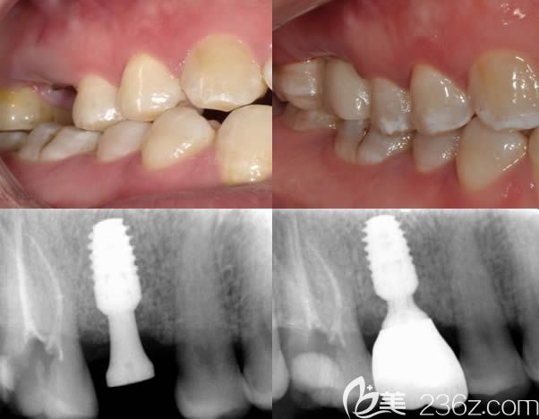北京牙管家口腔<!--<i data=20240703-sp></i>-->波美學種植案例效果前后對比圖