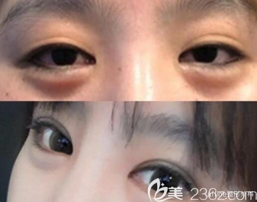 韓國raffine整形外科皮膚科眼部綜合整形案例效果對(duì)比圖 韓國raffine整形外科皮膚科眼部綜合整形案例效果對(duì)比圖