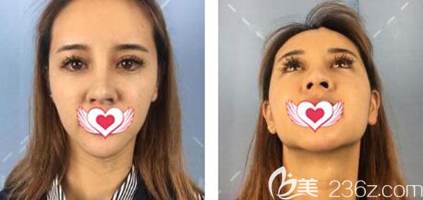 在昆明夢(mèng)想做鼻修復(fù)手術(shù)前 在昆明夢(mèng)想做鼻修復(fù)手術(shù)前