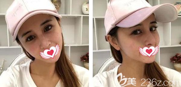 隆鼻失敗二次修復(fù)第7天腫脹不明顯 隆鼻失敗二次修復(fù)第7天腫脹不明顯