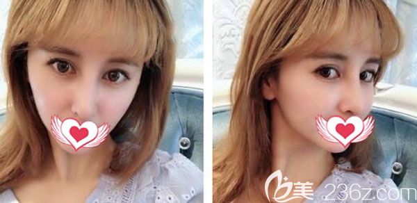 肋軟骨隆鼻一個(gè)月弧度也很自然 肋軟骨隆鼻一個(gè)月弧度也很自然