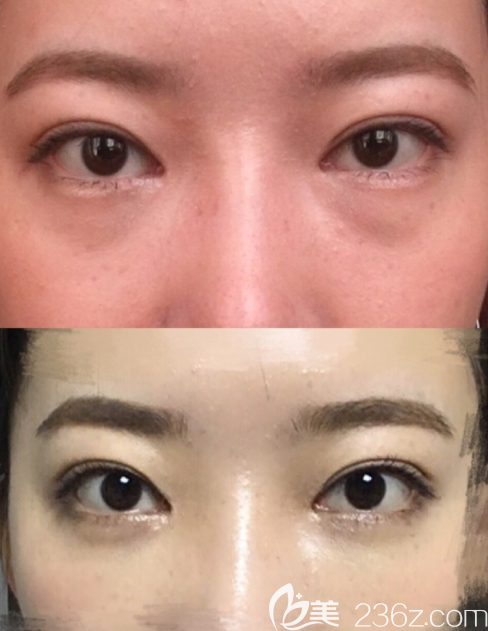 說(shuō)說(shuō)在韓國(guó)st整形金相泰眼底再排列+脂肪移植祛眼袋的經(jīng)歷吧