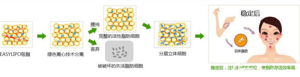 脂肪移植手術(shù)過程示意圖 脂肪移植手術(shù)過程示意圖