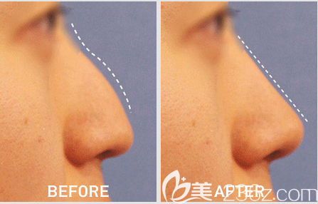 韓國(guó)lucea隆鼻手術(shù)<span style=